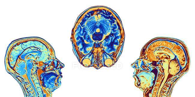 Компьютер увеличил ложноцветные магнитно-резонансные изображения (МРТ) двух средних сагиттальных и одной осевых (поперечных) секций через голову нормальной 46-летней женщины, показывающие структуры головного мозга, позвоночника и лицевых тканей . — стоковое фото