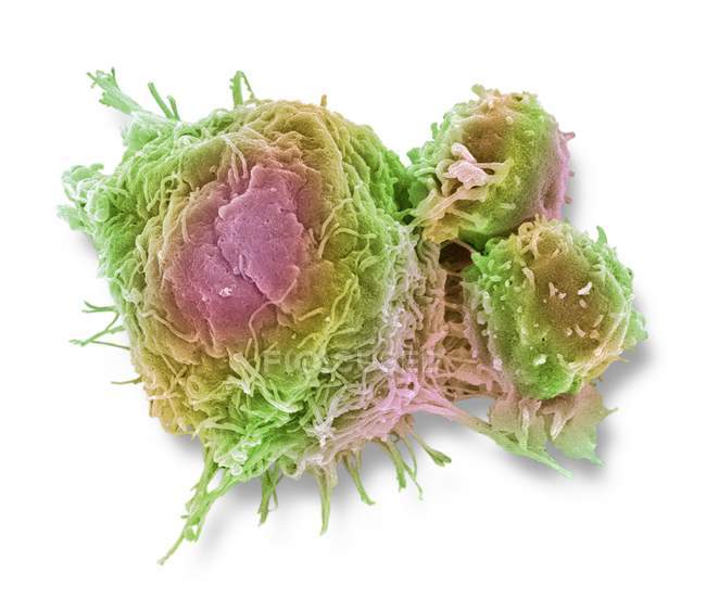 Células linfocíticas T adheridas a células cancerosas - foto de stock