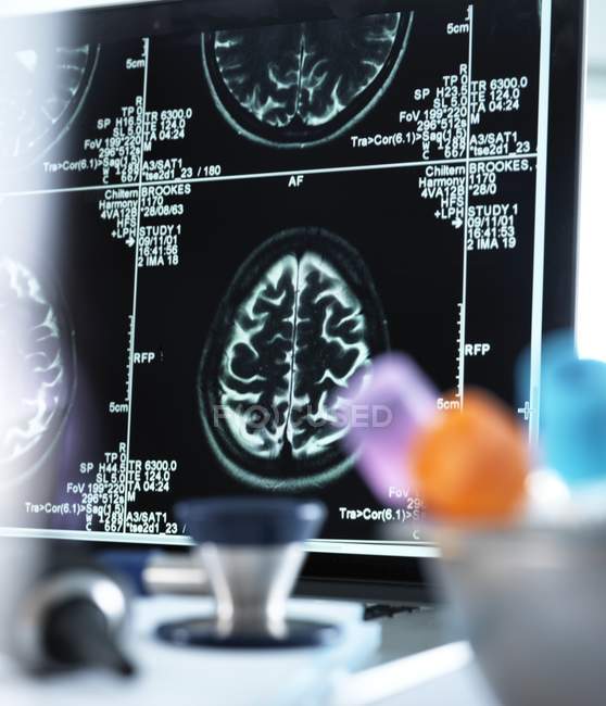 Сканирование мозга, отображаемое на экране — стоковое фото