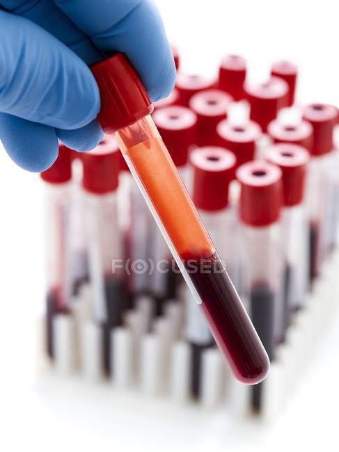 Mano enguantada sosteniendo la muestra de sangre en tubo de ensayo . - foto de stock