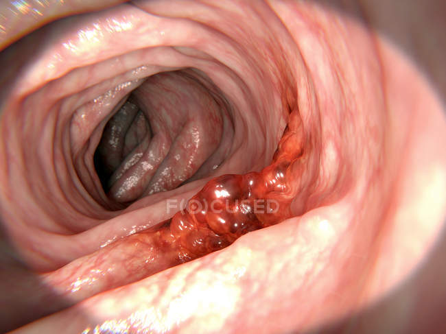 Tumore maligno del colon — Foto stock