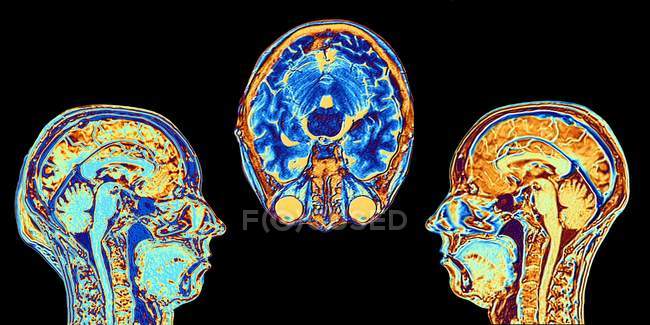 Imágenes de Resonancia Magnética (RM) de dos secciones sagitales medias y una axial (de sección transversal) a través de la cabeza de una mujer normal de 46 años, mostrando estructuras del cerebro, la columna vertebral y los tejidos faciales . - foto de stock