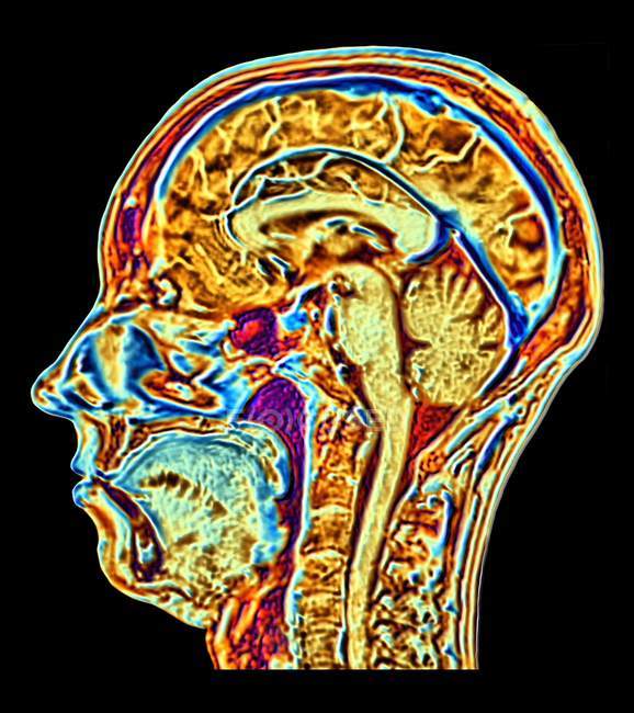 Imagen de Resonancia Magnética (RM) de color falso mejorada por computadora de una sección sagital media a través de la cabeza de una mujer normal de 46 años, mostrando estructuras del cerebro, la columna vertebral y los tejidos faciales. . - foto de stock