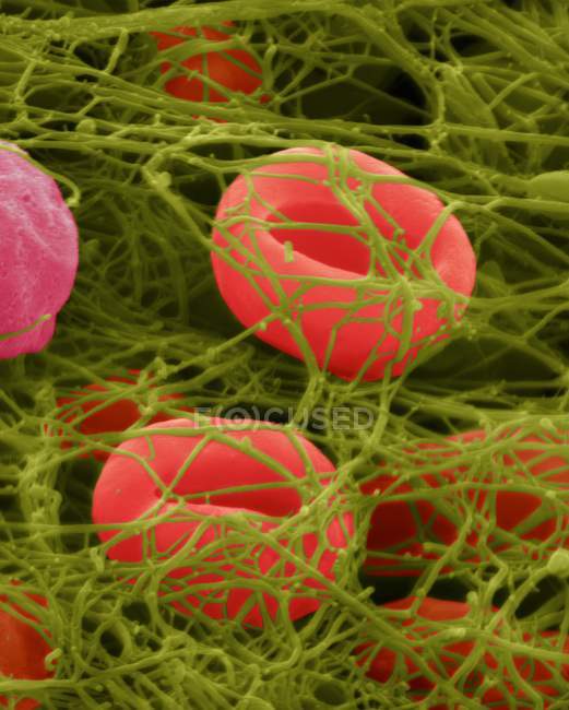 Menschliche rote Blutkörperchen, die in einem Fibrin-Blutgerinnsel gefangen sind, farbige Rasterelektronenmikroskopie (sem). — Stockfoto