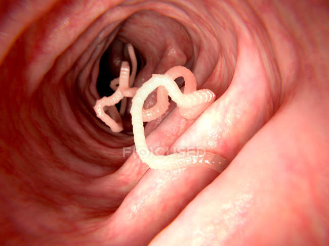 Tapeworm en intestino humano - foto de stock