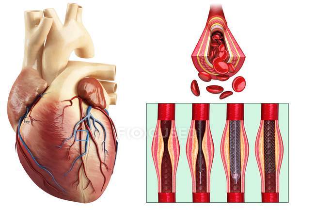 Inserimento stent angioplastica coronarica — Foto stock