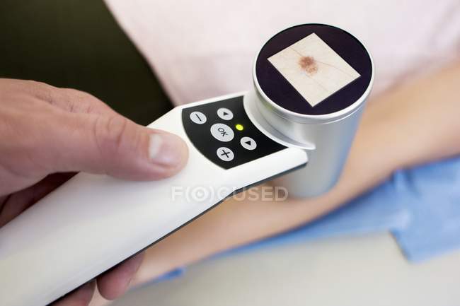 Primo piano del dermatoscopio digitale che esamina la talpa sul braccio del paziente . — Foto stock