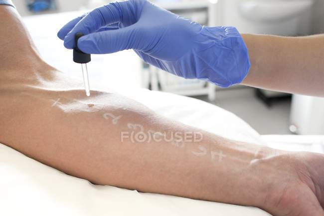 Paziente sottoposto a test di puntura cutanea in clinica allergologica . — Foto stock