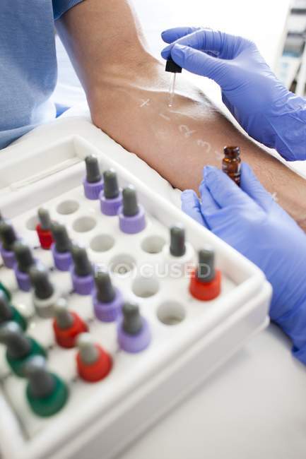 Paciente sometido a una prueba de pinchazo cutáneo en clínica de alergia
. - foto de stock