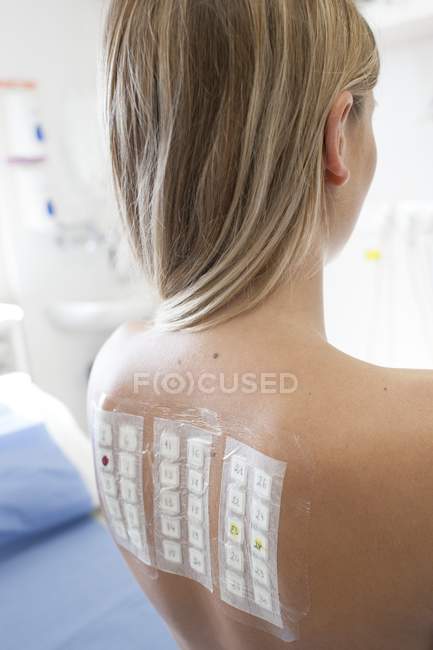 Paciente femenina sometida a prueba de parche en clínica de alergia
. - foto de stock