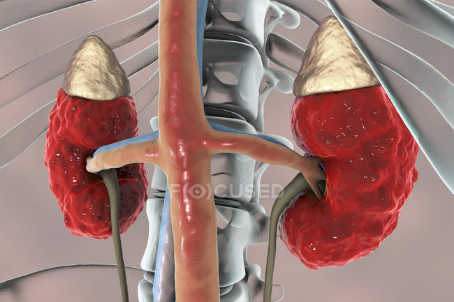 Ilustração digital da anatomia macroscópica dos rins com glomerulonefrite crônica
. — Fotografia de Stock