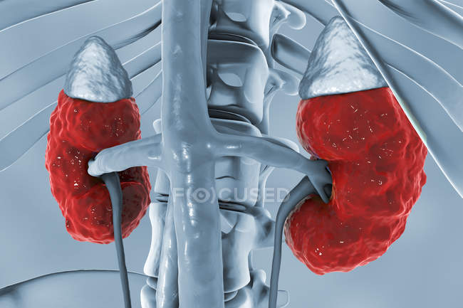 Ilustración digital de anatomía macroscópica de riñones con glomerulonefritis crónica . - foto de stock
