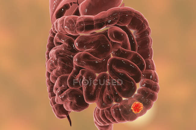 Colon cancer on plain background, digital illustration. — Stock Photo