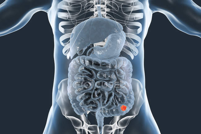 Cáncer de colon en el cuerpo humano, ilustración digital
. - foto de stock