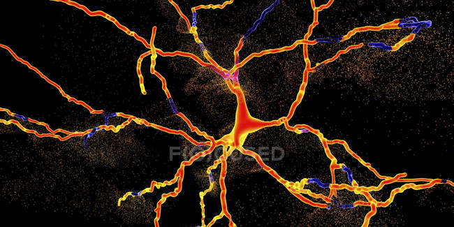Ilustración conceptual de la degeneración de neuronas dopaminérgicas
. - foto de stock