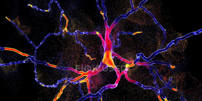 Концептуальна ілюстрація дегенерації дофамінергічних нейронів . — стокове фото