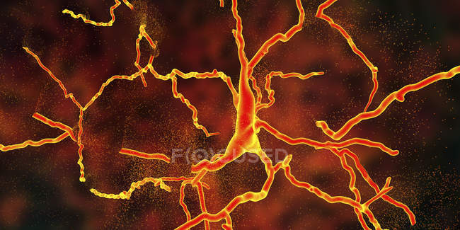 Концептуальная иллюстрация дегенерации дофаминергических нейронов . — стоковое фото