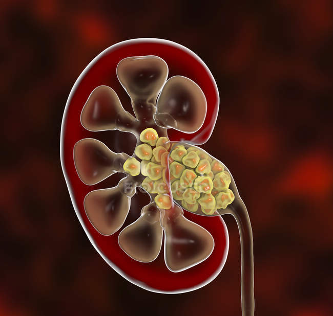 Ilustración digital de la sección del riñón humano que contiene cálculos renales
. - foto de stock