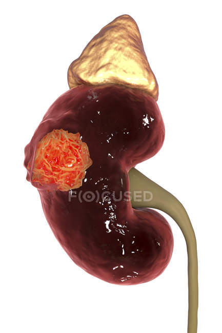 Digital illustration of kidney cancer. — Stock Photo