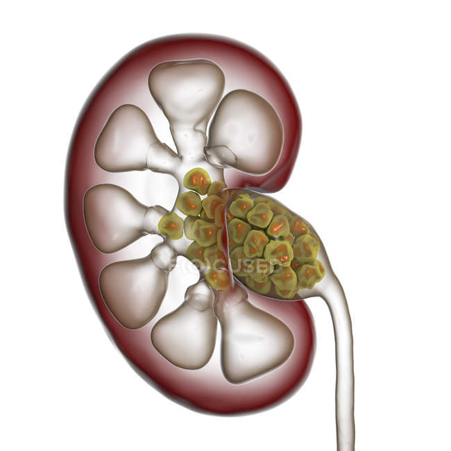 Цифровий ілюстрація того розділу людини нирок, що містить каменів у нирках. — стокове фото