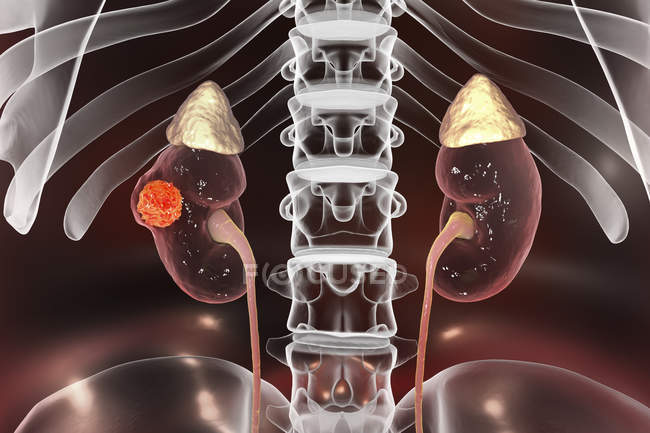 Цифрова ілюстрація раку нирок . — стокове фото
