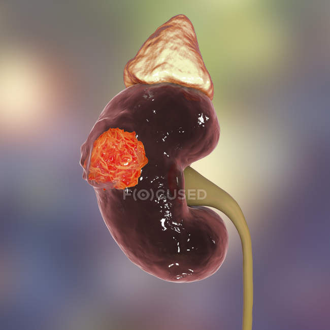 Ilustración digital del cáncer de riñón
. - foto de stock