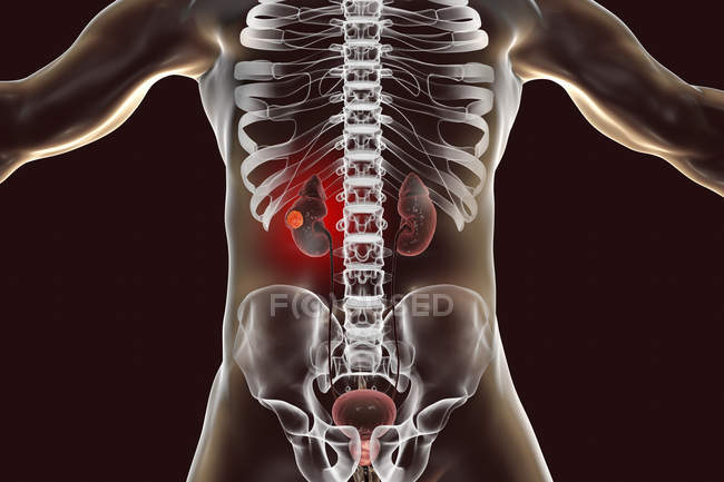 Ilustración digital del cuerpo humano con cáncer de riñón
. - foto de stock