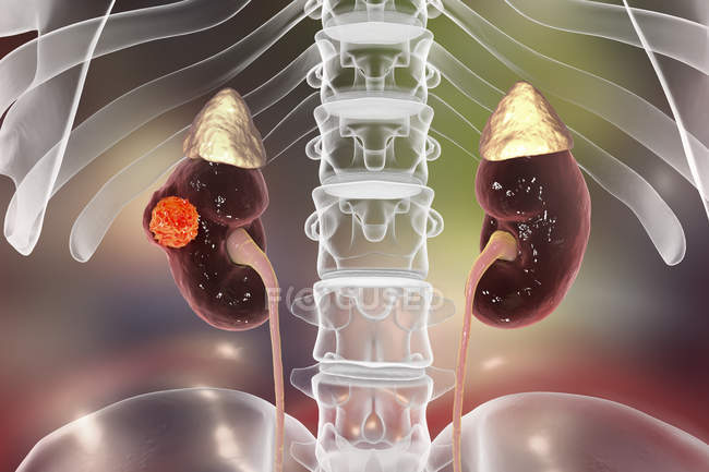 Digitale Illustration von Nierenkrebs. — Stockfoto