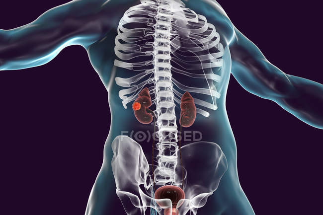Цифровий ілюстрація людського тіла з раком нирок. — стокове фото
