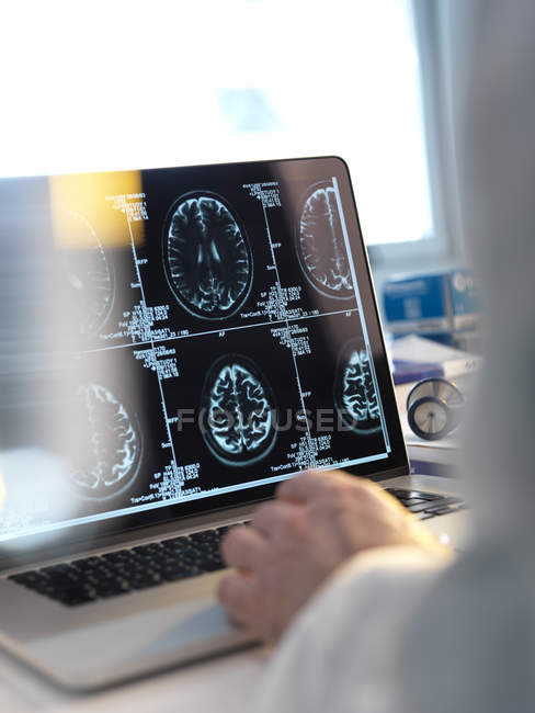 Доктор переглядає сканування мозку на екрані комп'ютера . — стокове фото
