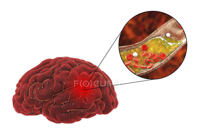Ilustración de bloqueo arterial que causa accidente cerebrovascular debido a la aterosclerosis
. - foto de stock