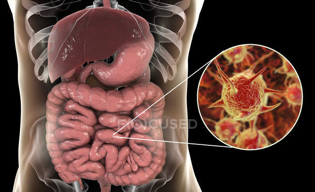 Obra digital de microorganismo patógeno abstracto en el intestino grueso humano
. - foto de stock