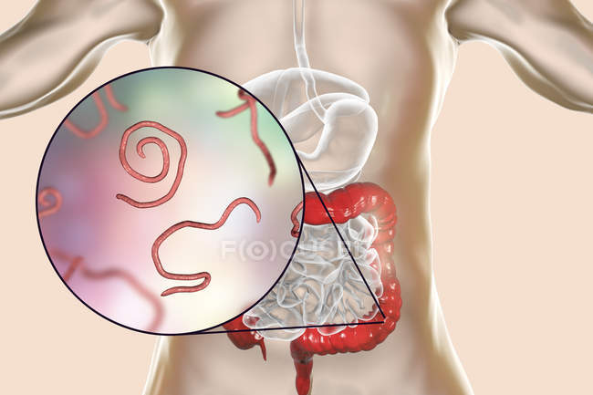 Digital illustration of multiple threadworms in human intestine. — Stock Photo