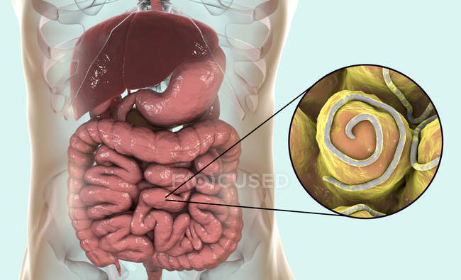 Ilustración digital de la lombriz en el intestino humano . - foto de stock