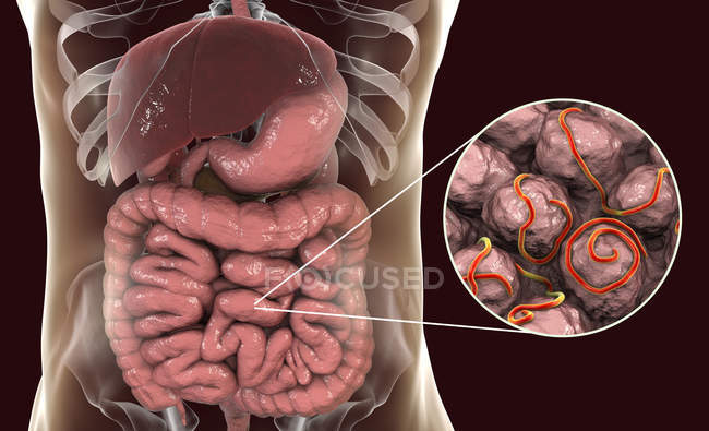 Ilustración digital de múltiples gusanos en el intestino humano
. - foto de stock