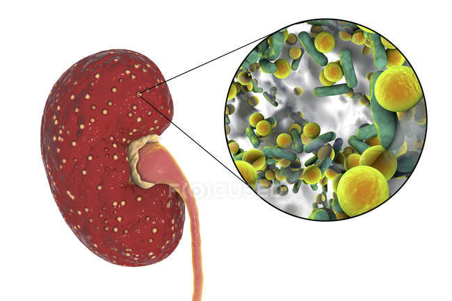 Illustration gelber Abszesse an der Niere und Nahaufnahmen von Enterokokken-Bakterien. — Stockfoto