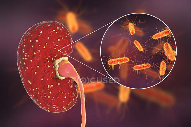Ilustración de abscesos amarillos en el riñón y primer plano de bacterias
. - foto de stock