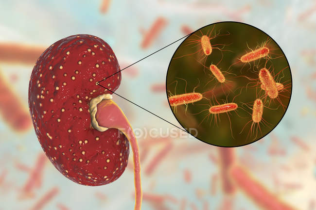 Ilustración de abscesos amarillos en el riñón y primer plano de la bacteria Escherichia
. - foto de stock