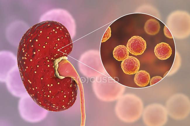Ilustración de abscesos amarillos en el riñón y primer plano de la bacteria Enterococcus . - foto de stock