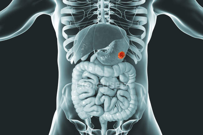 Cáncer de estómago en el cuerpo humano, ilustración digital
. - foto de stock