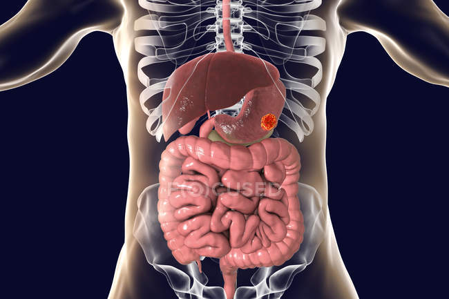 Stomach cancer in human body, digital illustration. — Stock Photo