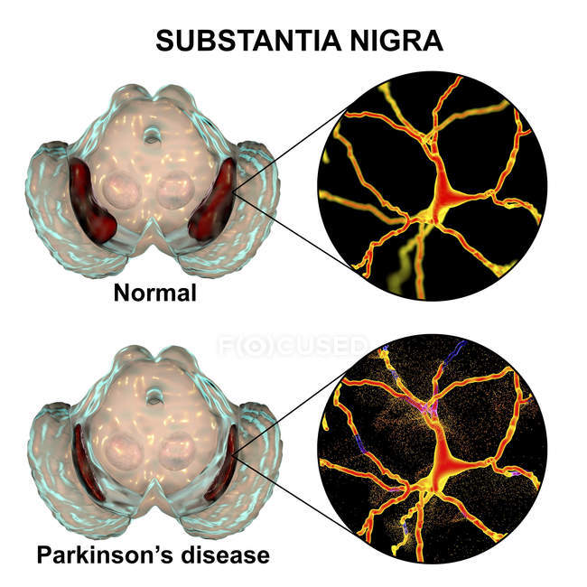 Darstellung gesunder und degenerierter Substantia nigra menschlicher Gehirne mit dopaminergen Neuronen. — Stockfoto