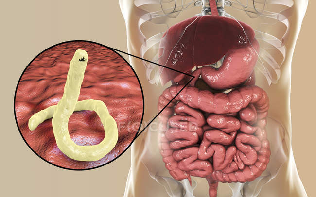 Ilustración digital del anquilostoma parásito Ancylostoma duodenale en el intestino delgado
. - foto de stock
