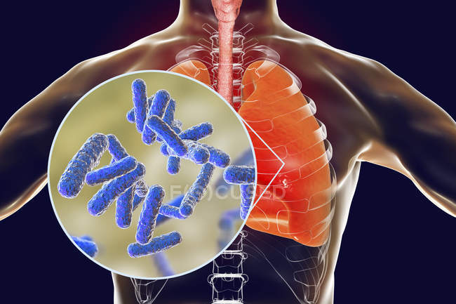 Poumons humains avec pneumonie bactérienne et gros plan sur les bactéries
. — Photo de stock