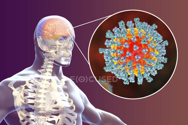 Энцефалит головного мозга человека, вызванный энтеровирусом кори, концептуальная иллюстрация
. — стоковое фото