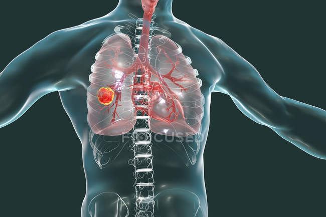 Menschliche Silhouette mit Lungenkrebs-Tumor, konzeptionelle Illustration. — Stockfoto