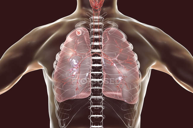 Ilustración digital de ganglio sólido en pulmón derecho cerca del ápice pulmonar, mientras que la infección tuberculosa secundaria
. - foto de stock