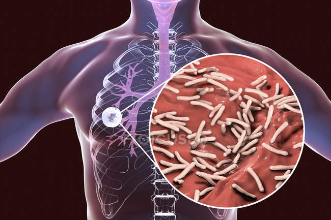 Tuberculosis pulmonar fibrocavernosa y primer plano de la bacteria Mycobacterium tuberculosis
. — Stock Photo