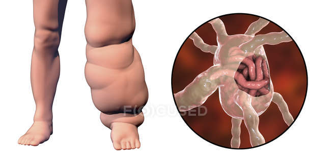 Цифровий ілюстрація нога людини під впливом лімфатичного філяріатоза і макро черв'яків паразитичні нематоди. — стокове фото