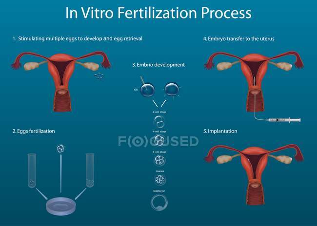 Proceso de fertilización in vitro, ilustraciones digitales . - foto de stock